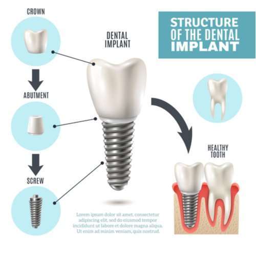 dental implant diagram leicester
